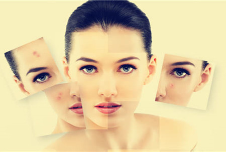 祛痘也要將就方法，不然后果很嚴重