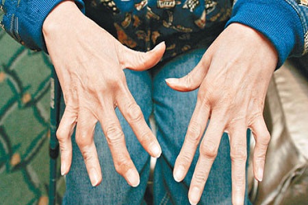 中醫(yī)治療風濕病的基本常識需知曉 中醫(yī)治療風濕病的基本常識需知曉