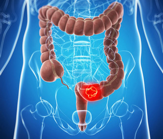 吃早餐可以預防膽結石形成的原因 吃早餐可以預防膽結石形成的原因