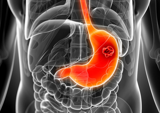 吃早餐可以預防膽結石形成的原因 吃早餐可以預防膽結石形成的原因