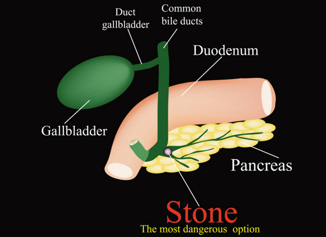 吃早餐可以預防膽結石形成的原因 吃早餐可以預防膽結石形成的原因