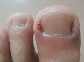 怎樣預防兒童甲溝炎如何治療 怎樣預防兒童甲溝炎如何治療