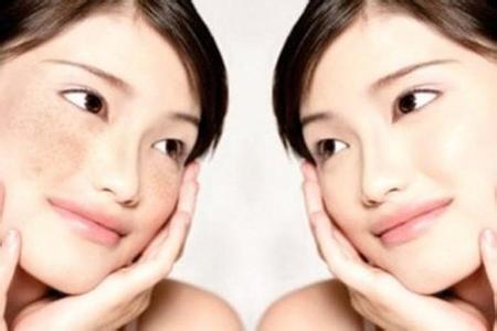 激光去雀斑多少錢 會反彈嗎 激光去雀斑多少錢 會反彈嗎