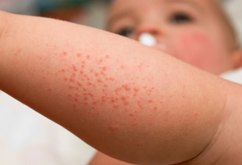 幼兒濕疹如何治療.png 幼兒濕疹如何治療.png