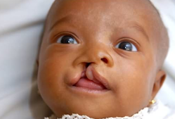 寶寶兔唇如何治療.png 寶寶兔唇如何治療.png