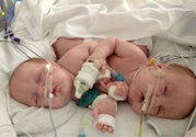連體嬰兒是怎么形成的 能檢查出來(lái)嗎