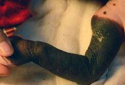 獸皮痣原因是什么怎么治療.png 獸皮痣原因是什么怎么治療.png