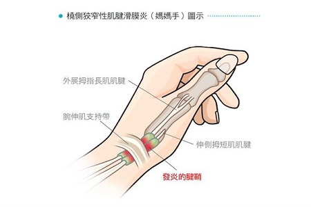 媽媽手檢測 媽媽手檢測