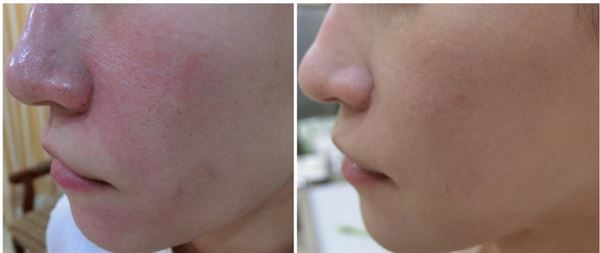 酒糟性皮膚炎反復(fù)發(fā)作怎么辦?新招能改善 酒糟性皮膚炎反復(fù)發(fā)作怎么辦?新招能改善