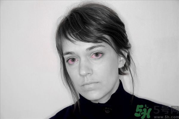 過敏性結膜炎可以揉眼睛嗎 常見過敏原及引發(fā)癥狀