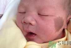 寶寶身上有胎記長大后會消失嗎.png 寶寶身上有胎記長大后會消失嗎.png