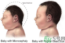 什么是塞卡病毒?如何傳染的?怎么預(yù)防最有效? 什么是塞卡病毒?如何傳染的?怎么預(yù)防最有效?
