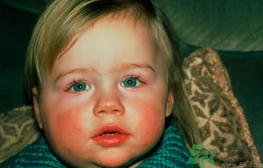 小孩得了三線炎怎么辦?得了三線炎吃什么好?.png 小孩得了三線炎怎么辦?得了三線炎吃什么好?.png