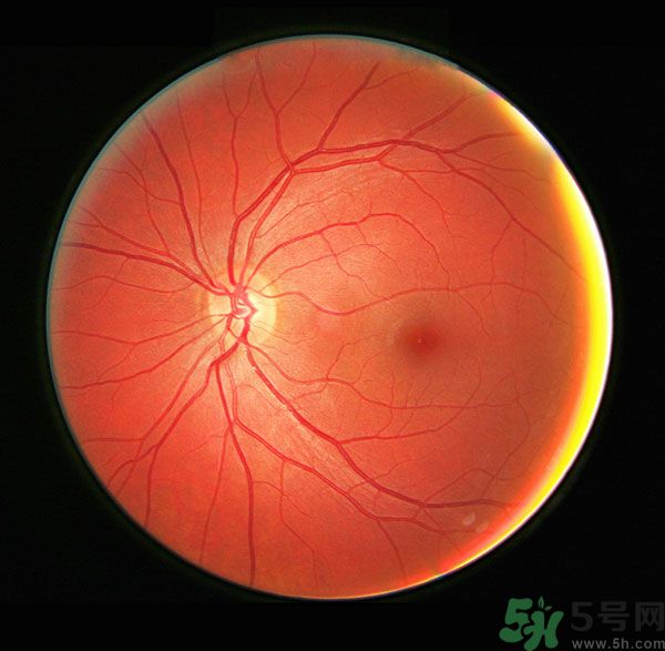 得了紅眼病可以吃雞蛋嗎 紅眼病能不能吃雞蛋 得了紅眼病可以吃雞蛋嗎 紅眼病能不能吃雞蛋