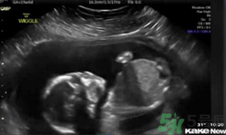 子宮內(nèi)胎兒自打臉 揭秘胎兒子宮內(nèi)生活.png 子宮內(nèi)胎兒自打臉 揭秘胎兒子宮內(nèi)生活.png