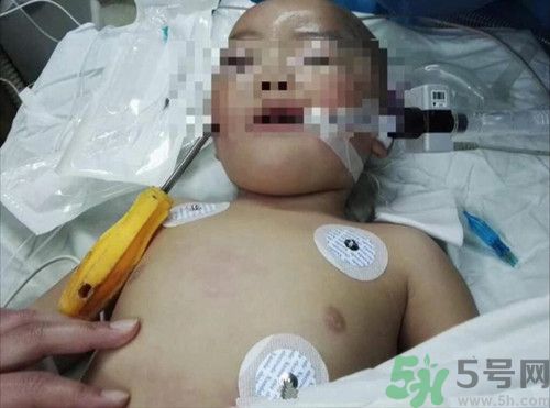 螺絲刀插入一歲女童頭部 螺絲刀插入一歲女童頭部