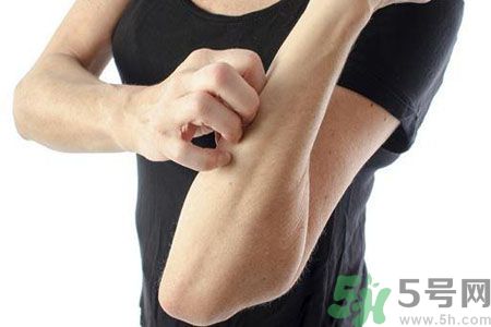 皮膚炎癢是怎么回事？皮膚炎發(fā)作怎么治療？