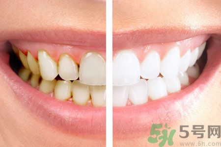牙齒有黃斑怎么辦？牙齒有黃斑怎么去除？