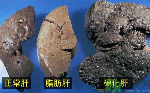 得了脂肪肝該怎么治？脂肪肝對(duì)人體危害有多大？