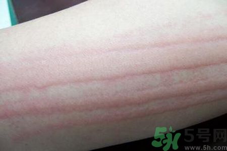 蕁麻疹會(huì)不會(huì)傳染？蕁麻疹怎么治才能好？