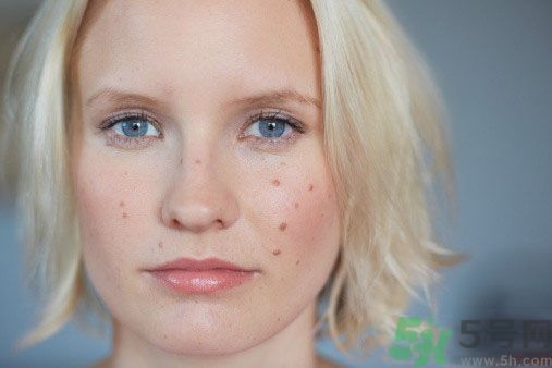 為什么會長痘痘？痘痘有哪幾種類型的？