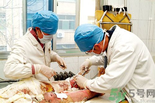 男將妻子雙手按入油鍋致二級(jí)燒傷 二級(jí)燒傷嚴(yán)重嗎?怎么處理 男將妻子雙手按入油鍋致二級(jí)燒傷 二級(jí)燒傷嚴(yán)重嗎?怎么處理