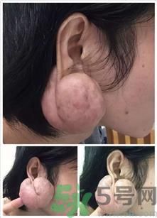 小伙戴耳釘長(zhǎng)出大肉瘤,亂打耳洞的危害? 小伙戴耳釘長(zhǎng)出大肉瘤,亂打耳洞的危害?