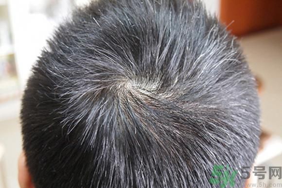 白頭發(fā)越拔越多是真的嗎?白頭發(fā)越拔越多是什么原因 白頭發(fā)越拔越多是真的嗎?白頭發(fā)越拔越多是什么原因