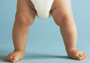 孩子一個(gè)腿長(zhǎng)一個(gè)腿短是什么??？孩子長(zhǎng)短腿怎么辦？