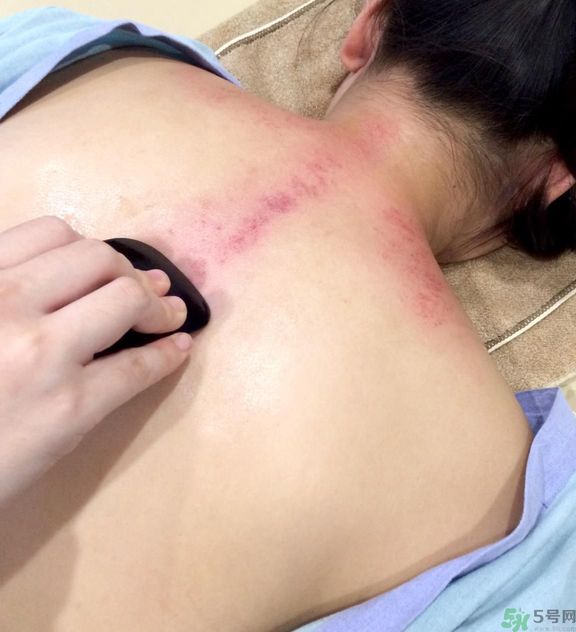 刮痧的好處有那些？夏季刮痧要注意什么？