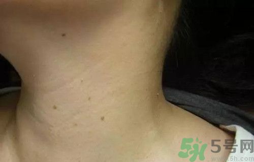 脖子長小肉粒是怎么回事?脖子長小肉粒怎么去除 脖子長小肉粒是怎么回事?脖子長小肉粒怎么去除