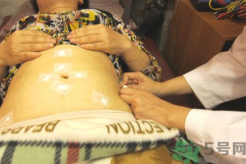 埋線減肥怎么做?埋線減肥和針灸減肥哪個(gè)效果好 埋線減肥怎么做?埋線減肥和針灸減肥哪個(gè)效果好