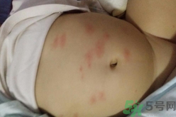 孕婦肚子上長紅點點是怎么回事?孕婦肚子上長紅點點怎么辦?.png 孕婦肚子上長紅點點是怎么回事?孕婦肚子上長紅點點怎么辦?.png