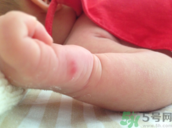 被蚊子咬了起紅點(diǎn)怎么消除?被蚊子咬會(huì)得什么病 被蚊子咬了起紅點(diǎn)怎么消除?被蚊子咬會(huì)得什么病