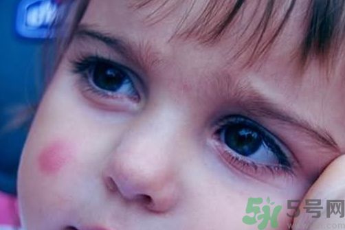 寶寶被蚊子咬了涂什么藥膏安全又有效? 寶寶被蚊子咬了涂什么藥膏安全又有效?