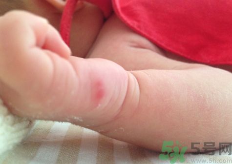 寶寶被蚊子咬了涂什么藥膏安全又有效? 寶寶被蚊子咬了涂什么藥膏安全又有效?