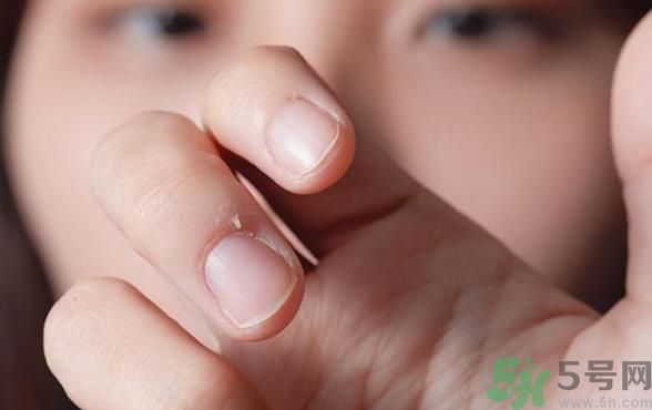 手指倒刺拔掉了手指腫了怎么辦?手指倒刺的原因 手指倒刺拔掉了手指腫了怎么辦?手指倒刺的原因