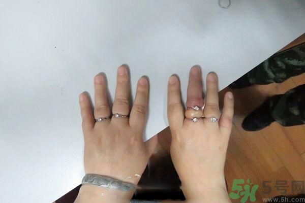 女子被5枚戒指咬手是什么原因