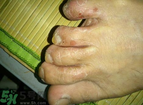 云南白藥可以治腳氣嗎?云南白藥能治腳氣嗎? 云南白藥可以治腳氣嗎?云南白藥能治腳氣嗎?