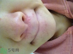 嘴巴周圍長痘的原因是什么?嘴巴周圍長痘怎么治療? 嘴巴周圍長痘的原因是什么?嘴巴周圍長痘怎么治療?