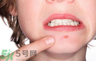 嘴巴周圍長痘的原因是什么?嘴巴周圍長痘怎么治療? 嘴巴周圍長痘的原因是什么?嘴巴周圍長痘怎么治療?