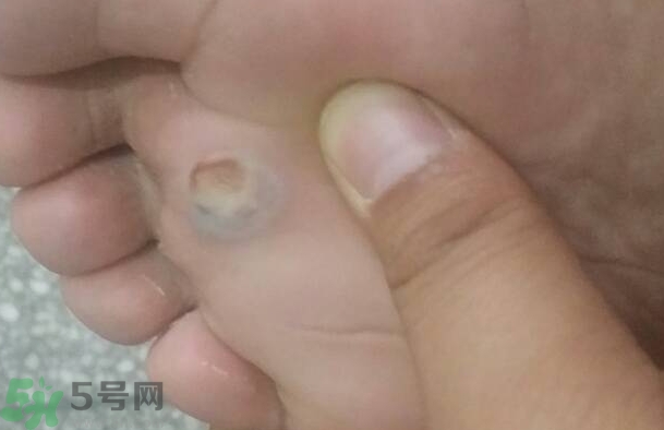 夏天腳脫皮起泡是怎么回事?夏天腳脫皮起泡怎么辦?