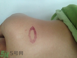 種草莓吻痕是什么意思？吻痕是怎么弄出來的？