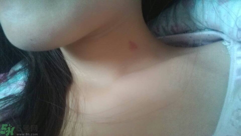 種草莓吻痕是什么意思？吻痕是怎么弄出來的？