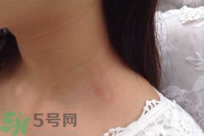 種草莓吻痕是什么意思？吻痕是怎么弄出來的？