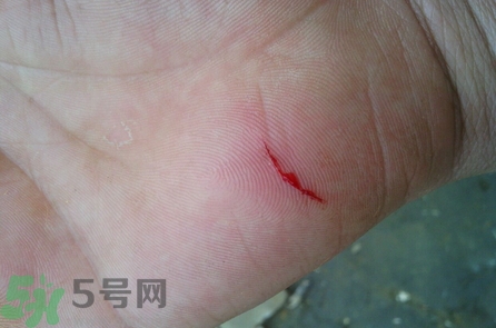 傷口脫痂后皮膚紅色怎么辦?傷口脫痂后皮膚顏色怎么恢復(fù)? 傷口脫痂后皮膚紅色怎么辦?傷口脫痂后皮膚顏色怎么恢復(fù)?