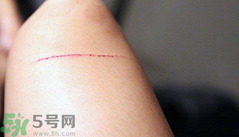 傷口脫痂后皮膚紅色怎么辦?傷口脫痂后皮膚顏色怎么恢復(fù)? 傷口脫痂后皮膚紅色怎么辦?傷口脫痂后皮膚顏色怎么恢復(fù)?