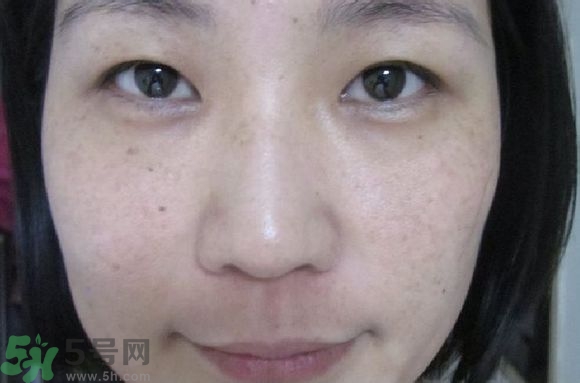 肝斑是肝有問(wèn)題嗎?肝斑怎么調(diào)理簡(jiǎn)單方法 肝斑是肝有問(wèn)題嗎?肝斑怎么調(diào)理簡(jiǎn)單方法