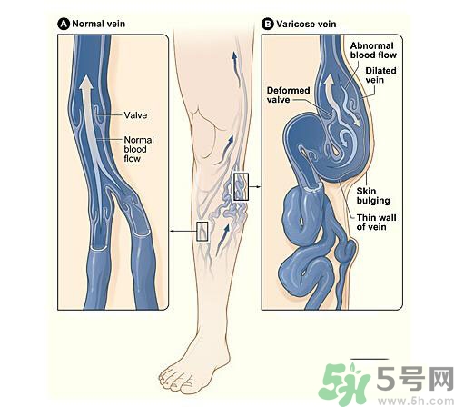 靜脈曲張?jiān)缙诎Y狀有哪些？靜脈曲張?jiān)缙诎Y狀