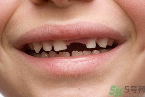 青少年牙齒松動(dòng)怎么辦？青少年怎么保護(hù)牙齒？